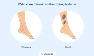 Wybroczyny i siniaki na nogach mogą być objawem białaczki. Po lewej wybroczyny, po prawej siniaki.