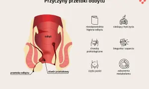 Ilustracja przedstawia anatomię odbytu z zaznaczoną przetoką odbytu. Obok wymieniono przyczyny: złą higienę, siedzący tryb życia, choroby proktologiczne, biegunkę, zaparcia, ciężki poród i zaburzenia metabolizmu.