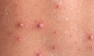 Początki ospy na skórze: drobne, czerwone krostki i pęcherzyki, niektóre z białym czubkiem.