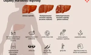 Ilustracja pokazuje zdrowe i chore wątroby, prezentując objawy marskości wątroby: ból brzucha, zmęczenie, utratę masy ciała, żółtaczkę, obrzęki, gorączkę i zmiany skórne.