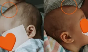 Dwa ujęcia główki niemowlaka, pokazujące jego ciemiączko.