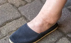 Obrzęk kostki, jeden z objawów chorej nerki, widoczny na stopie w czarnym bucie na tle kostki brukowej.