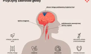 Ilustracja pokazuje przyczyny zawrotów głowy: problemy z krążeniem mózgu, infekcje ucha, choroby mózgu, leki, zaburzenia metaboliczne, sercowo-naczyniowe i układu przedsionkowego.