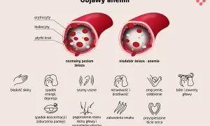 Objawy anemii: bladość skóry, spadek energii, szumy uszne, nerwowość, zmęczenie, bóle głowy, spadek koncentracji, pogorszenie stanu skóry i wypadanie włosów, zaburzenia smaku, przyspieszone bicie serca.
