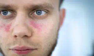 Czerwone plamy na policzkach mężczyzny, które mogą być objawem tocznia.