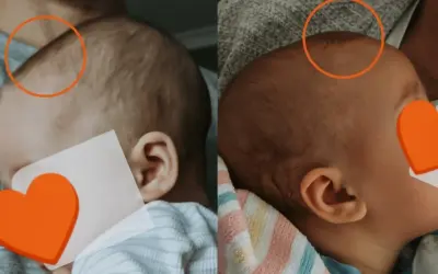 Dwa ujęcia główki niemowlaka, pokazujące jego ciemiączko.