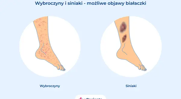 Wybroczyny i siniaki na nogach mogą być objawem białaczki. Po lewej wybroczyny, po prawej siniaki.