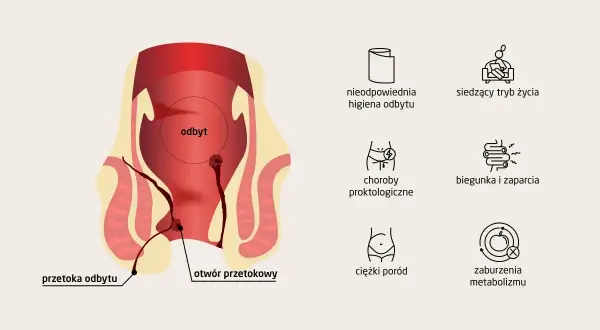 Ilustracja przedstawia anatomię odbytu z zaznaczoną przetoką odbytu. Obok wymieniono przyczyny: złą higienę, siedzący tryb życia, choroby proktologiczne, biegunkę, zaparcia, ciężki poród i zaburzenia metabolizmu.