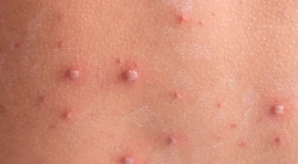 Początki ospy na skórze: drobne, czerwone krostki i pęcherzyki, niektóre z białym czubkiem.