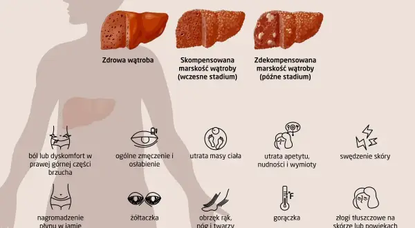 Ilustracja pokazuje zdrowe i chore wątroby, prezentując objawy marskości wątroby: ból brzucha, zmęczenie, utratę masy ciała, żółtaczkę, obrzęki, gorączkę i zmiany skórne.