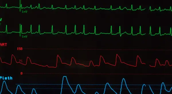 Monitor EKG pokazuje nieregularne fale, mogące wskazywać na migotanie przedsionków objawy.