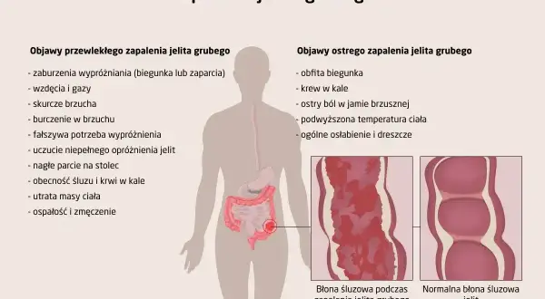 Objawy zapalenia jelit: biegunka, krew w kale, ból brzucha, gorączka, osłabienie. Ilustracja pokazuje zmiany w błonie śluzowej jelita.