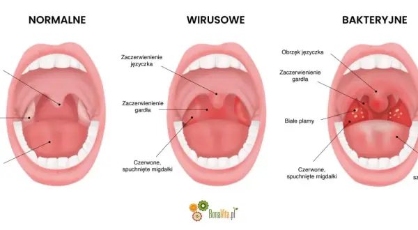 Porównanie gardła: normalne, wirusowe (zaczerwienienie, obrzęk języczka) i bakteryjne (białe plamy, szary język).