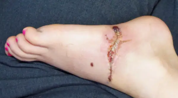 Stopa z raną pooperacyjną, która zaczyna wykazywać objawy gangreny. Widoczne są ciemne, martwicze tkanki i zaczerwienienie.