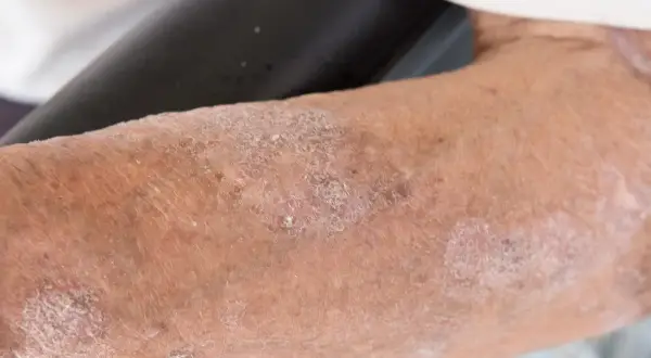 Skóra z widocznymi zmianami, łuszczeniem i zaczerwienieniem, sugerującymi problem dermatologiczny, być może orungal.