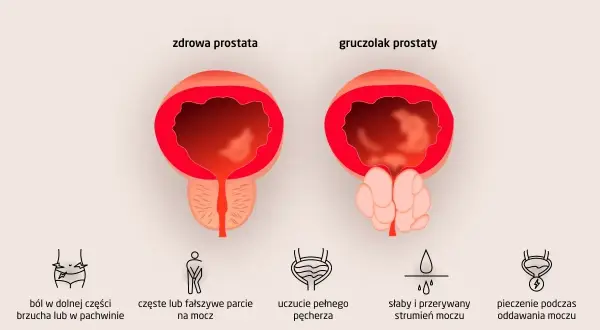 Porównanie zdrowej prostaty i gruczolaka. Objawy raka prostaty: ból brzucha, częste parcie na mocz, słaby strumień, pieczenie.