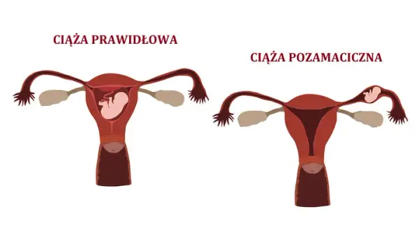 Ciąża pozamaciczna a test ciążowy - co musisz wiedzieć?
