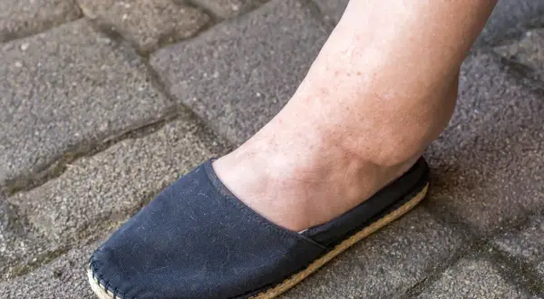 Obrzęk kostki, jeden z objawów chorej nerki, widoczny na stopie w czarnym bucie na tle kostki brukowej.