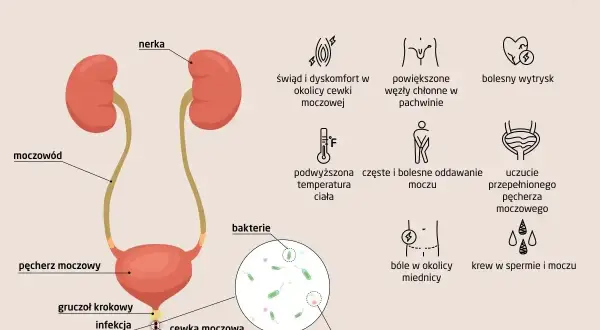 Objawy zapalenia cewki moczowej: pieczenie, ból, gorączka, krew w moczu, bolesny wytrysk. Infekcja bakteryjna cewki moczowej.