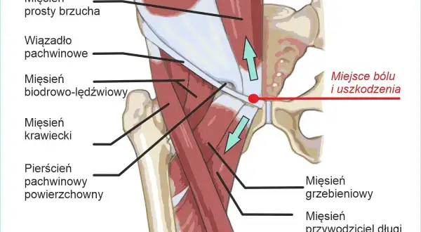 Anatomia pachwiny z zaznaczonym miejscem bólu i uszkodzenia. Ilustracja pokazuje mięśnie brzucha, biodrowo-lędźwiowy, krawiecki oraz pierścień pachwinowy.