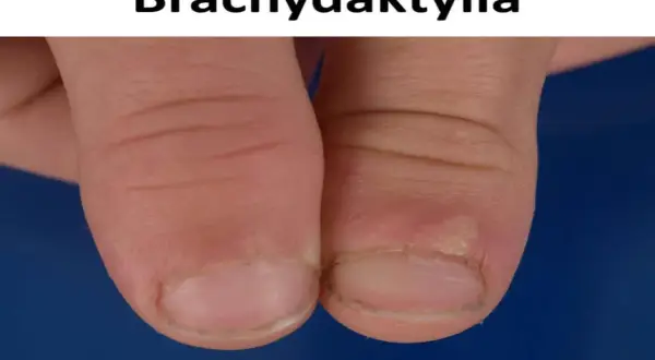 Zbliżenie na palce dłoni z widocznymi krótkimi paznokciami i skórkami, ilustrujące brachydaktylię.
