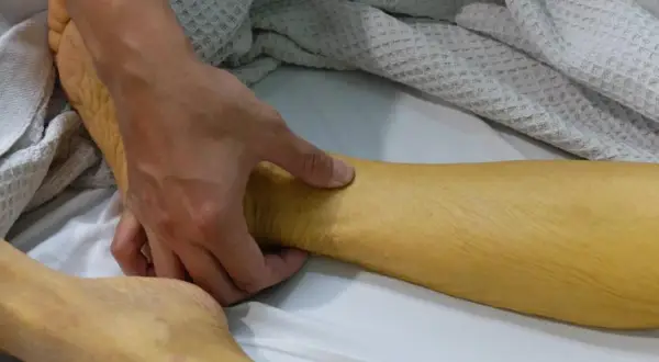 Dłoń bada zażółconą skórę nogi, która może wskazywać na wzw a.