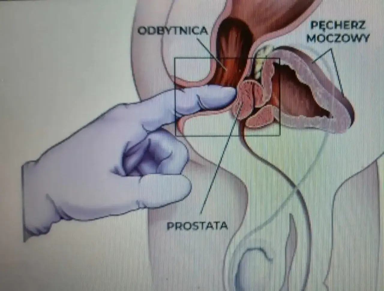 Ilustracja medyczna pokazująca palec w rękawiczce wykonujący masaż prostaty przez odbytnicę.