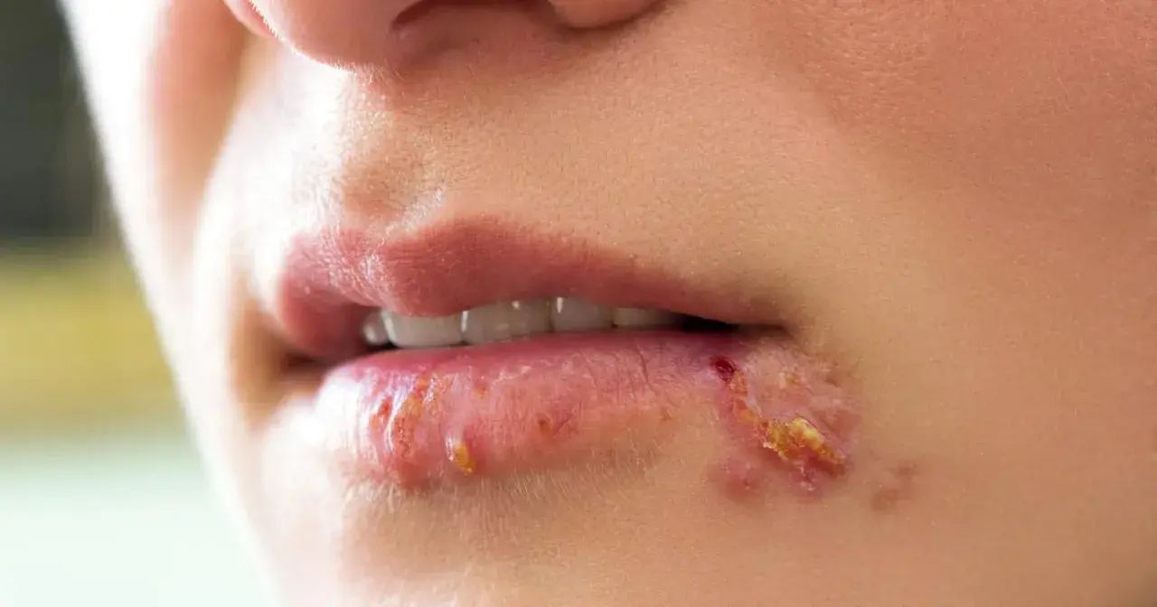 Opryszczka na ustach, która może wymagać leczenia hascovirem.