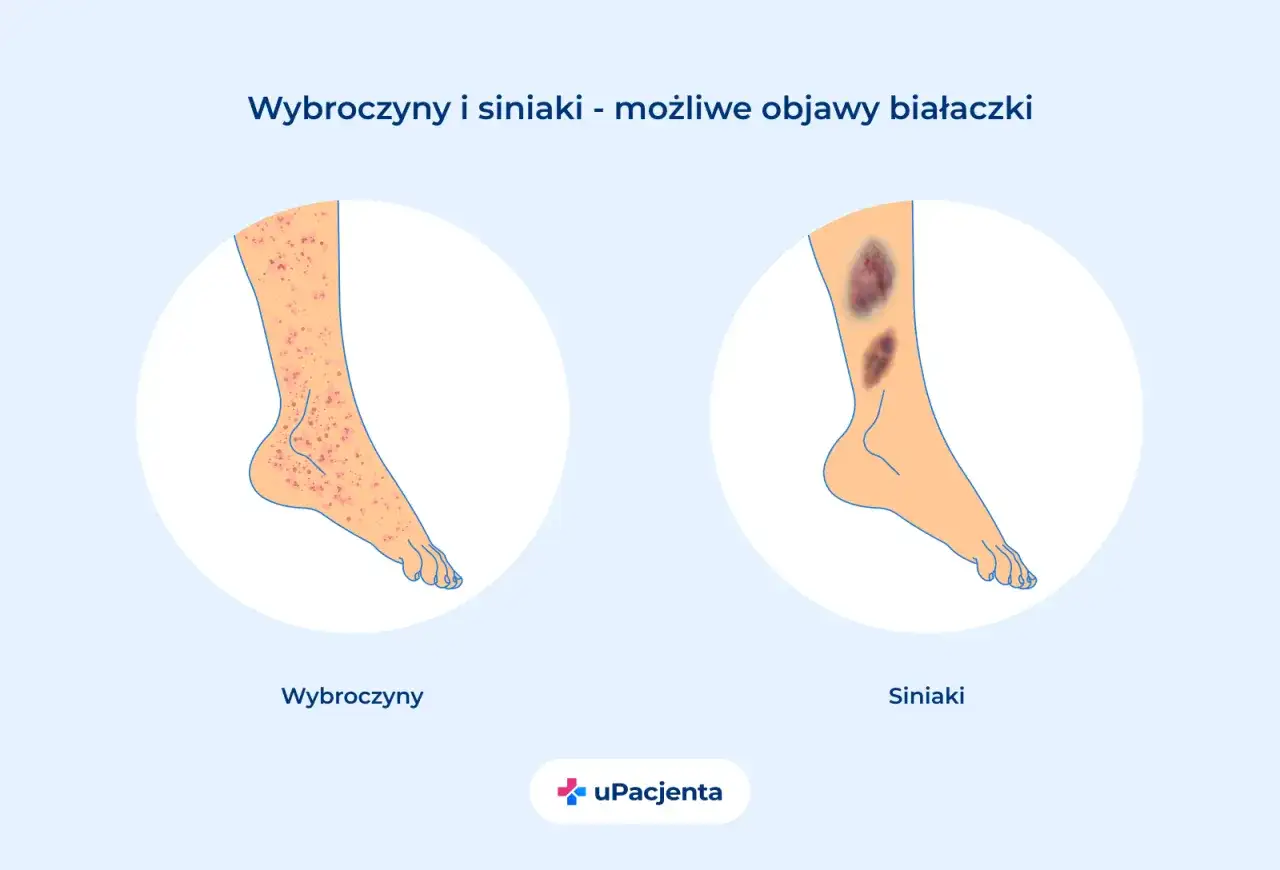Wybroczyny i siniaki na nogach mogą być objawem białaczki. Po lewej wybroczyny, po prawej siniaki.