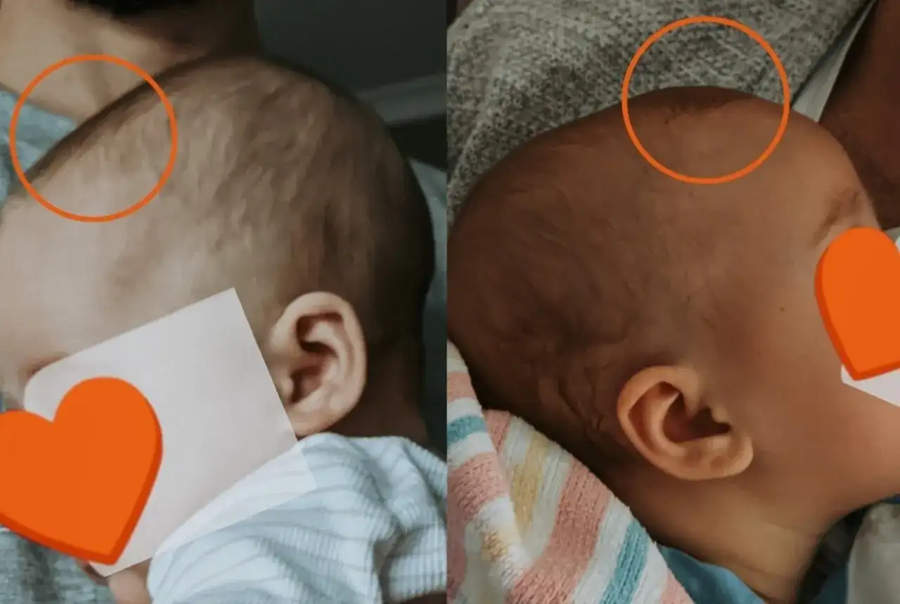 Dwa ujęcia główki niemowlaka, pokazujące jego ciemiączko.
