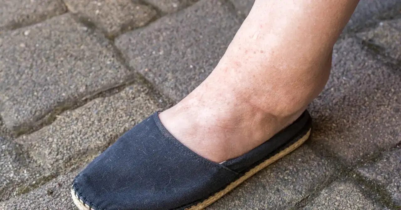 Obrzęk kostki, jeden z objawów chorej nerki, widoczny na stopie w czarnym bucie na tle kostki brukowej.