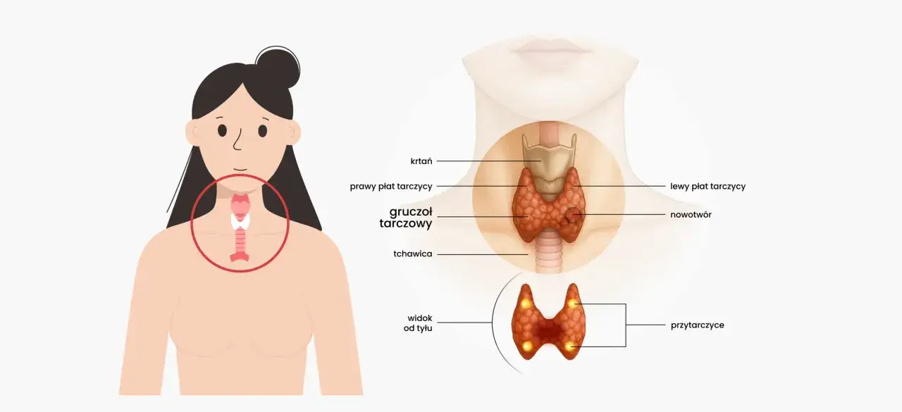 Ilustracja przedstawia anatomię tarczycy, gruczołu, którego dysfunkcja może prowadzić do choroby Hashimoto. Widoczny nowotwór.
