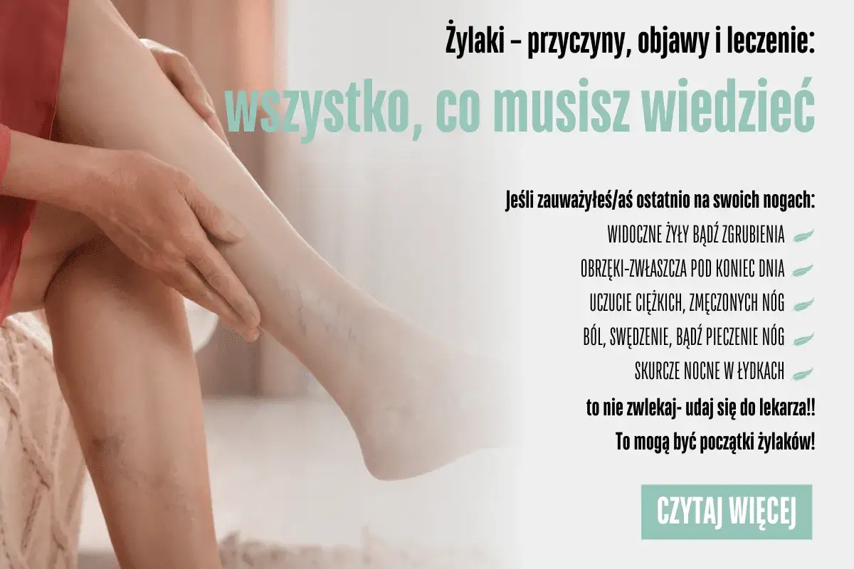 Widoczne żylaki na nogach? Sprawdź objawy i dowiedz się, jak leczyć. Nie czekaj, to może być początek problemów z żyłami.