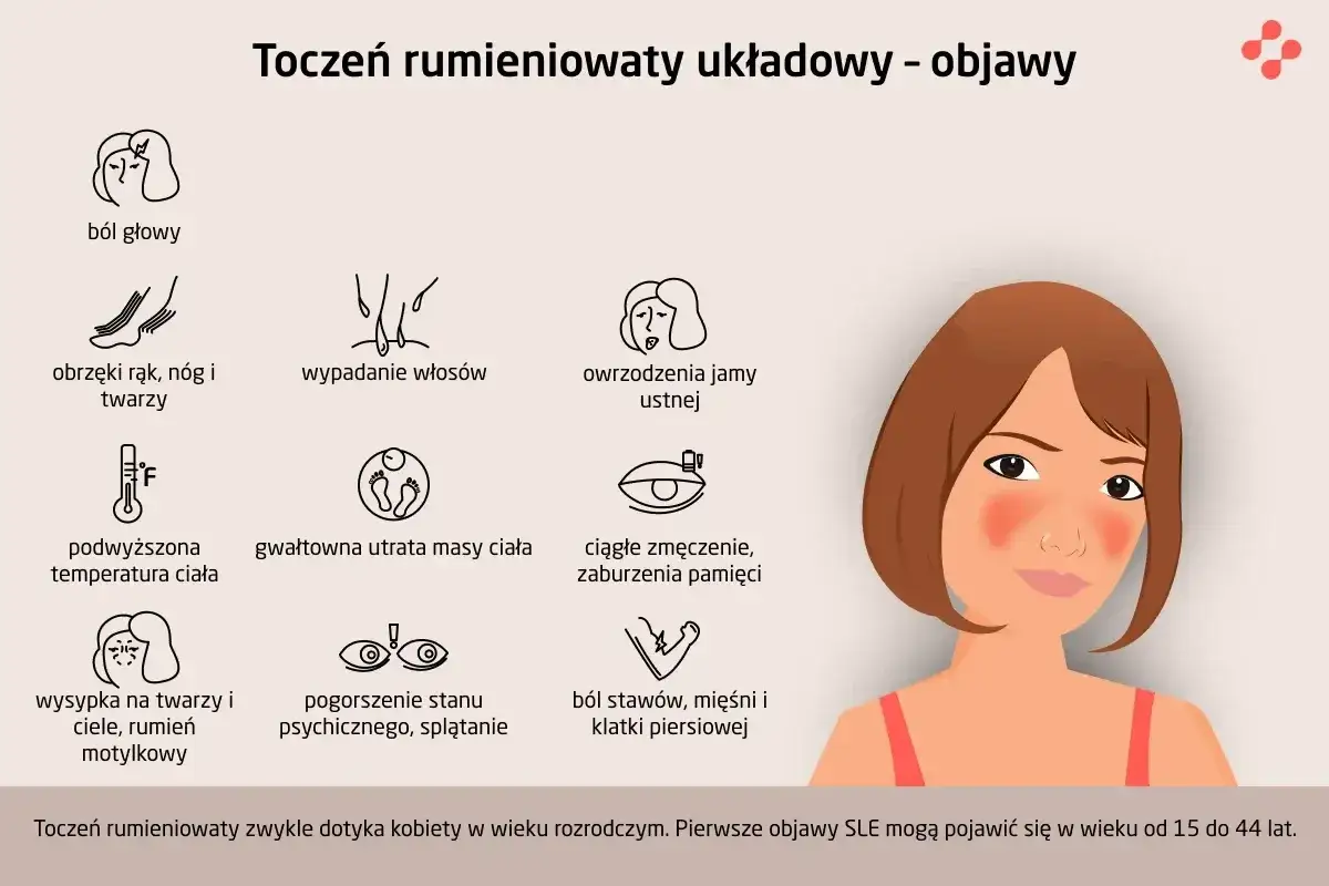 Toczeń rumieniowaty układowy - objawy: ból głowy, wysypka, zmęczenie, wypadanie włosów, owrzodzenia jamy ustnej, obrzęki, gorączka, utrata masy ciała, problemy z pamięcią, ból stawów.
