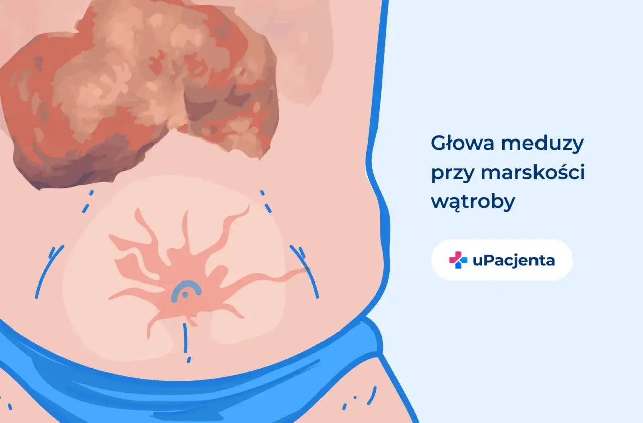 Głowa meduzy to jeden z objawów marskości wątroby. Widoczny na brzuchu rozszerzony układ żył.