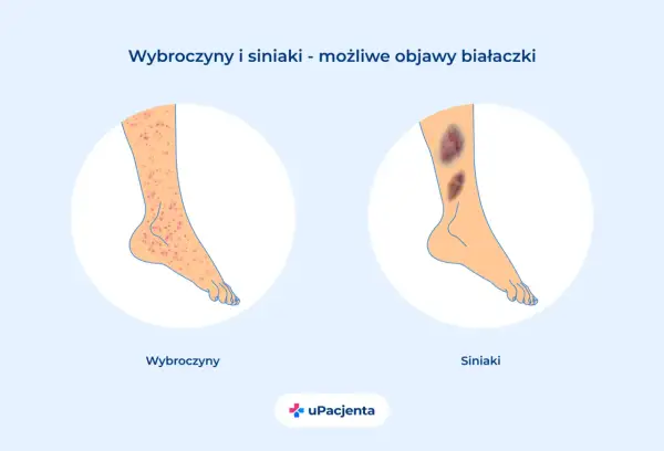 Wybroczyny i siniaki na nogach mogą być objawem białaczki. Po lewej wybroczyny, po prawej siniaki.