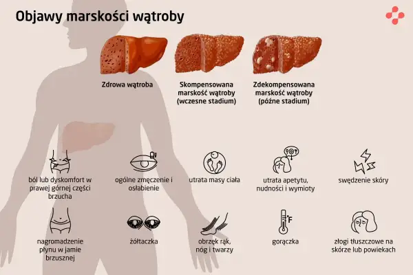 Ilustracja pokazuje zdrowe i chore wątroby, prezentując objawy marskości wątroby: ból brzucha, zmęczenie, utratę masy ciała, żółtaczkę, obrzęki, gorączkę i zmiany skórne.