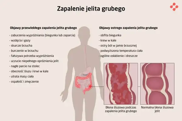Objawy zapalenia jelit: biegunka, krew w kale, ból brzucha, gorączka, osłabienie. Ilustracja pokazuje zmiany w błonie śluzowej jelita.