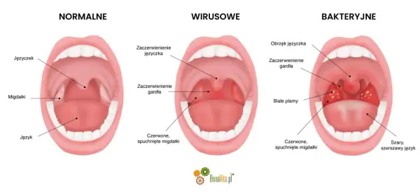 Porównanie gardła: normalne, wirusowe (zaczerwienienie, obrzęk języczka) i bakteryjne (białe plamy, szary język).