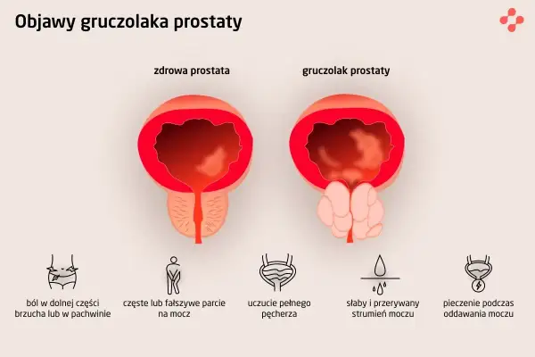 Porównanie zdrowej prostaty i gruczolaka. Objawy raka prostaty: ból brzucha, częste parcie na mocz, słaby strumień, pieczenie.