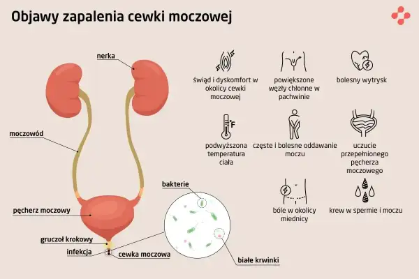 Objawy zapalenia cewki moczowej: pieczenie, ból, gorączka, krew w moczu, bolesny wytrysk. Infekcja bakteryjna cewki moczowej.