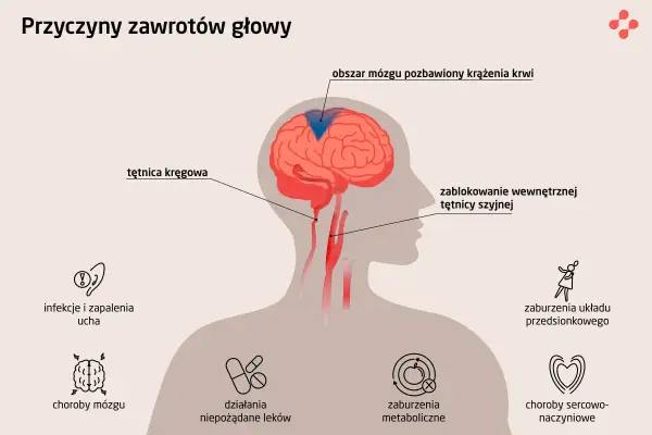 Ilustracja pokazuje przyczyny zawrotów głowy: problemy z krążeniem mózgu, infekcje ucha, choroby mózgu, leki, zaburzenia metaboliczne, sercowo-naczyniowe i układu przedsionkowego.