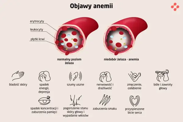 Objawy anemii: bladość skóry, spadek energii, szumy uszne, nerwowość, zmęczenie, bóle głowy, spadek koncentracji, pogorszenie stanu skóry i wypadanie włosów, zaburzenia smaku, przyspieszone bicie serca.