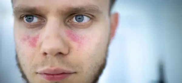 Czerwone plamy na policzkach mężczyzny, które mogą być objawem tocznia.