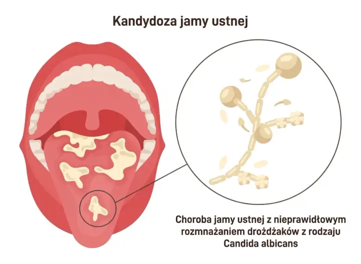 Kandydoza jamy ustnej: białe naloty na języku i podniebieniu. Powiększony obraz drożdżaków Candida. Objawy kandydozy.