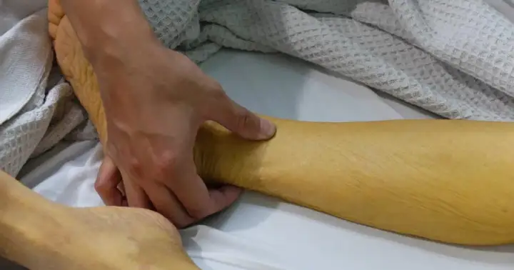 Dłoń bada zażółconą skórę nogi, która może wskazywać na wzw a.